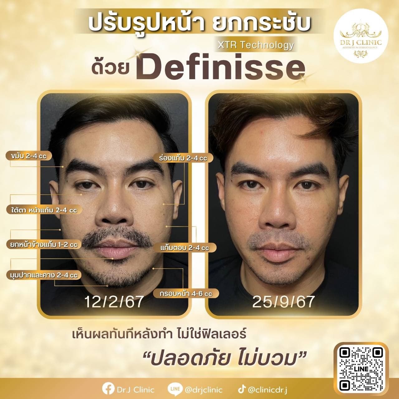 รูปก่อนและหลังปรับรูปหน้า ยกกระชับด้วย Definisse ที่ Dr. J Clinic – เทคนิค XTR ปรับรูปหน้าโดยไม่ใช้ฟิลเลอร์ เห็นผลทันที ปลอดภัย ไม่บวม