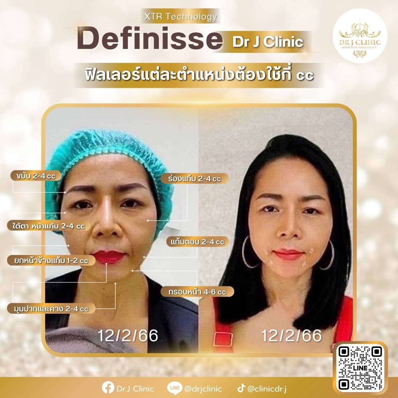 รูปก่อนและหลังปรับรูปหน้าด้วย Definisse ที่ Dr. J Clinic – ยกกระชับหน้า เติมเต็มร่องแก้ม ปรับรูปคางและกรอบหน้าโดยใช้เทคนิค XTR ไม่ใช้ฟิลเลอร์ เห็นผลทันที