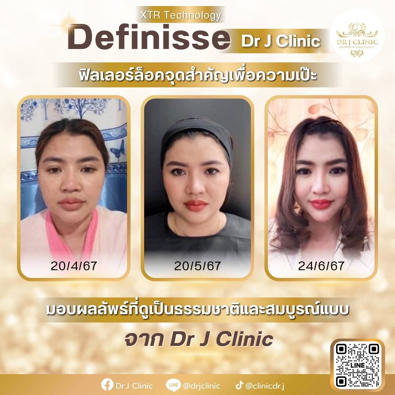 รูปก่อนและหลังปรับรูปหน้าด้วย Definisse ที่ Dr. J Clinic – ฟิลเลอร์ล็อคจุดสำคัญเพื่อความเป๊ะ ยกกระชับ ปรับรูปหน้าให้ดูเป็นธรรมชาติและสมบูรณ์แบบ ด้วยเทคนิค XTR