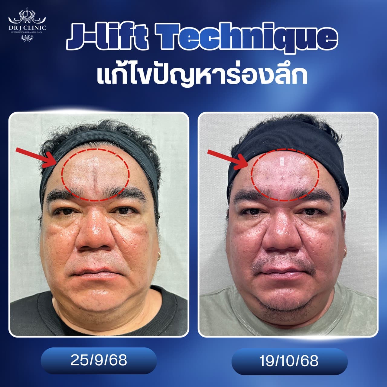 รูปก่อนและหลังปรับรูปหน้าด้วย Definisse ที่ Dr. J Clinic – ฟิลเลอร์ล็อคจุดสำคัญเพื่อความเป๊ะ ยกกระชับ ปรับรูปหน้าให้ดูเป็นธรรมชาติและสมบูรณ์แบบ ด้วยเทคนิค XTR